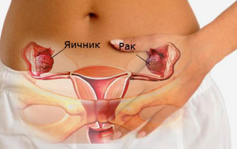 рак яичников