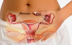 рак яичников