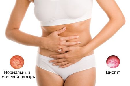 Цистит у взрослых: симптомы, причины, лечение